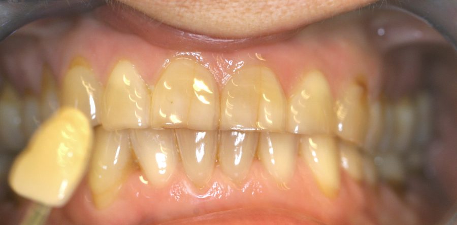 Dr Hitesh Batavia talks about Stress Management / Clenching / Grinding teeth